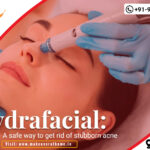 Hydrafacial A safe way to get rid of stubborn ace.